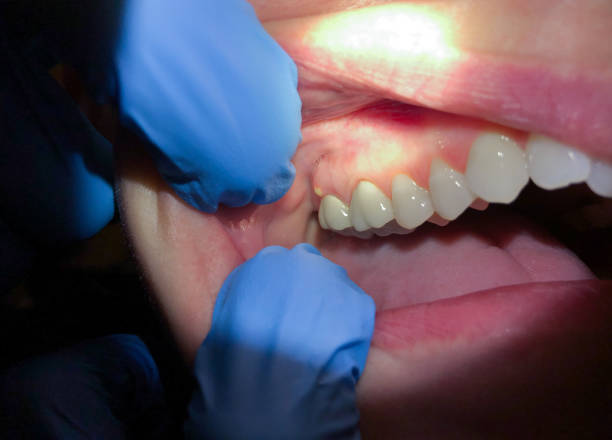 Best Emergency Wisdom Teeth Removal in Las Vegas, NM